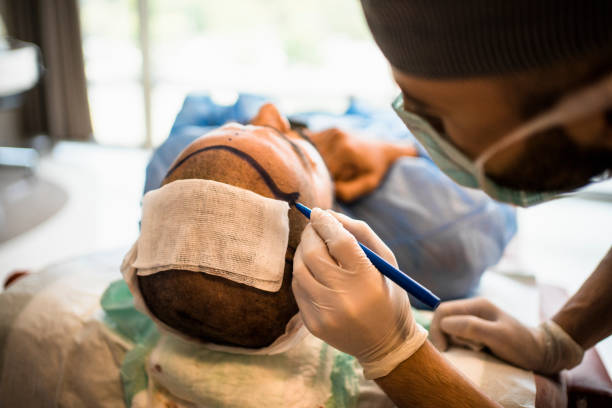 Hair transplant stock photo