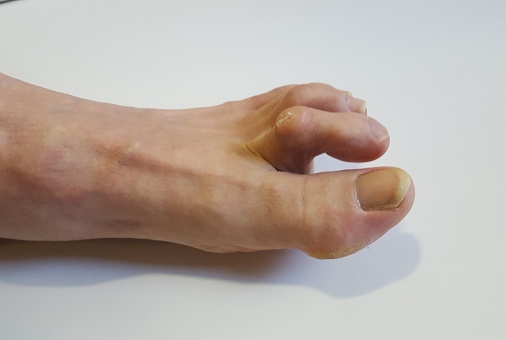 The left foot has a hammer toe with a white background.