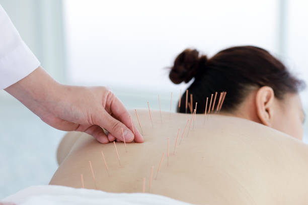 hand of doctor performing acupuncture therapy stock photo