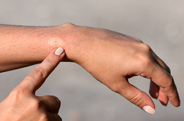 hand pointing to a persons wrist where they have a bee sting - wespen stockfoto's en -beelden
