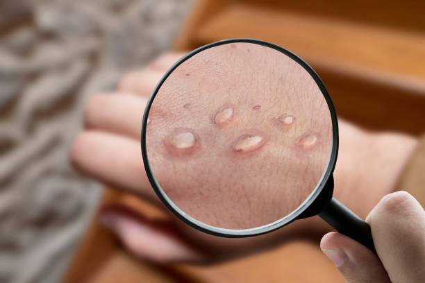 Hand with monkey pox rash A magnifying glass focusing on a vesicle rash created by monkey pox disease monkeypox vaccine stock pictures, royalty-free photos & images