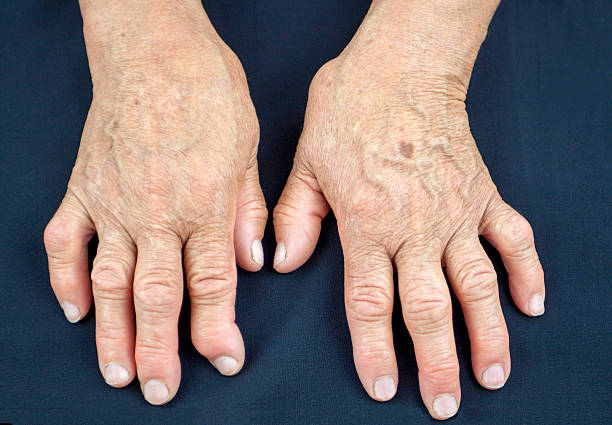 krónikus rheumatoid arthritis