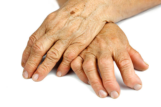 Început artroza articulațiilor, Cum se manifesta artroza la nivelul mainilor?
