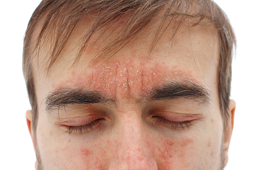 皮膚鼻額および頬の赤いアレルギー反応赤いアレルギー反応を持つ目を閉じた病気の男性の頭季節の皮膚の問題クローズアップ白い背景 はがれるのストックフォトや画像を多数ご用意 Istock