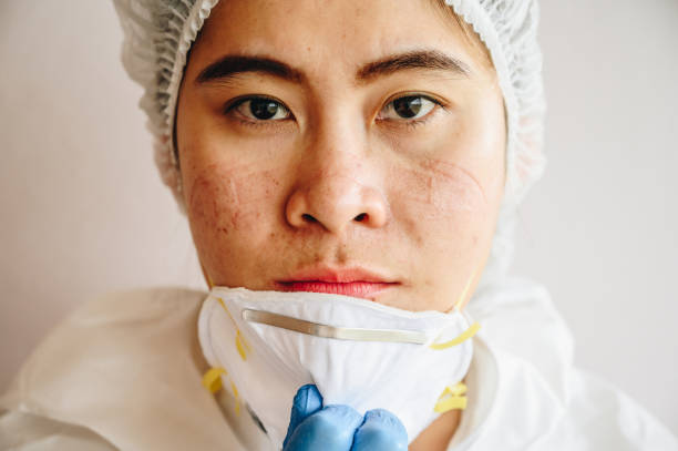 Healthcare worker with facial wounds from a medical mask after work for a long time in hospital during covid-19 pandemic. Wearing mask for prolonged periods can damage the skin. nurse face stock pictures, royalty-free photos & images