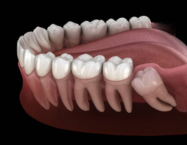 Healthy teeth and wisdom tooth with mesial impaction . Medically accurate tooth 3D illustration stock photo