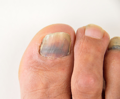 Hematoma In A Nail Stock Photo - Download Image Now - iStock