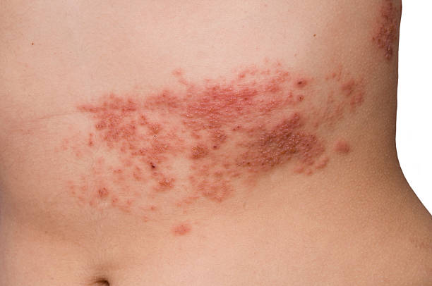 herpes herpes zoster rash shingles stock pictures, royalty-free photos & images