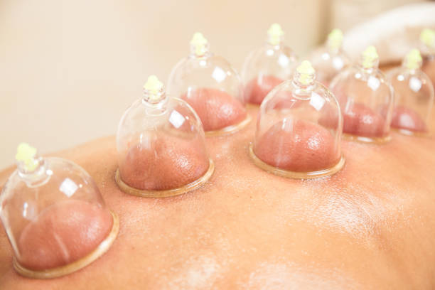 Hijama, wet cupping therapy. Series of realtherapy images, medicinal bleeding sensitive content stock photo