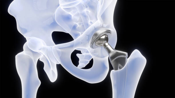 Hip implant stock photo
