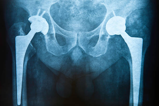 Hip replacement stock photo