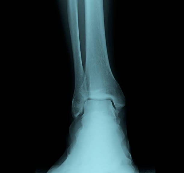 Human foot ankel and leg xray picture. stock photo