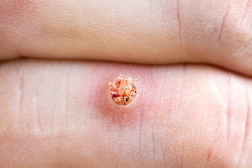 human papillomavirus infection without warts