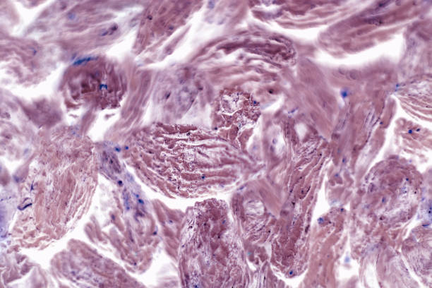 Human squamous cell carcinoma. Tissues affected by cancer cells under a microscope. stock photo