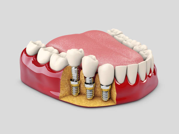 Types of Dental Implant. The American Academy of Implant Dentistry considers two types of implants to be safe. Endosteal implants — Most commonly placed implants are surgically implanted directly into the jawbone. Once the surrounding gum tissue has healed, a second surgery is needed to connect a post to the original implant. Finally, an artificial tooth (or teeth) is attached to the post-individually or grouped on a bridge or denture. Subperiosteal implants — These Dental implant are used with patients who do not have enough healthy bone. A metal frame is fitted onto the jawbone below the gum tissue. As the gums heal, the frame becomes fixed to the jawbone. Posts, which are attached to the frame, protrude through the gums. As with endosteal implants, artificial teeth are then mounted to the posts. Missing teeth can make you feel self-conscious when eating, talking or smiling, and create oral health problems for you as well. Dental implants are a great solution for improving your dental health, as well as your confidence.