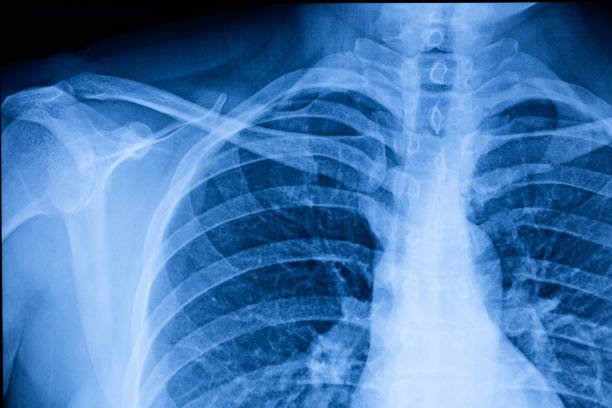 menselijke thoracale holte x-ray film - borstkas stockfoto's en -beelden