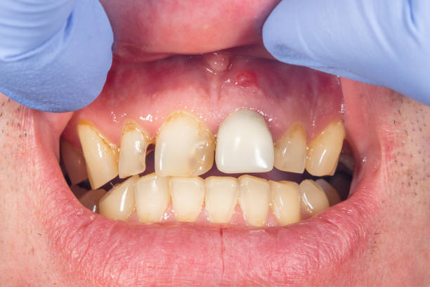 human tooth decay close-up at the dentist's appointment. Poor oral hygiene, prevention human tooth decay close-up at dentist's appointment. Poor oral hygiene, prevention rotten teeth in children stock pictures, royalty-free photos & images