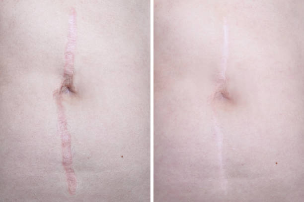 Hypertrophic keloid scar on woman stomach before and after laser treatment, removal, heal and recovery after accident or damage, cosmetology and pastic surgery solution stock photo