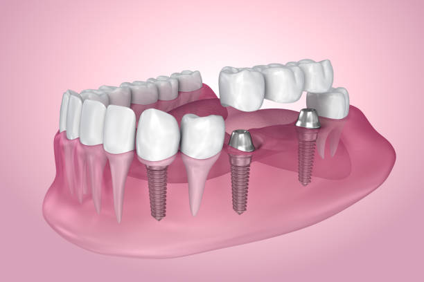 Implant-Supported Fixed Bridge with an implant-supported fixed bridge, it is not necessary to replace every single tooth with a single dental implant. Instead, the implant-supported fixed bridge will restore several missing teeth and it’s possible for this option to replace a complete arch of teeth. The number of implants required can vary according to the type of dental implant used by your implant dentist, and the number of teeth being restored. An implant-supported bridge looks very similar to a tooth-supported fixed bridge and can either be cemented or screwed into place. Sometimes an implant dentist will choose to screw the bridge onto the implants as this makes it easier to retrieve the bridge should it need cleaning or repairing. The screw holes in the bridge are covered up with tooth-colored composite resin so they are virtually invisible. Benefits Provides very good aesthetic results Feels and looks very natural, making it easy to speak and eat virtually anything Easy to look after and can be brushed and flossed just like an ordinary  Cost is lower compared to replacing every single tooth with a single dental implant Should last for many years before it needs replacing No need for your dentist to grind down healthy teeth Disadvantages Only suitable if the missing teeth are situated adjacent to each other Relatively expensive, particularly when used to restore a complete arch of teeth Requires a greater number of visits and treatment takes longer to complete compared to a tooth-supported fixed bridge or a denture Implant treatment does require a small surgical procedure When to Choose an Implant-Supported Fixed Bridge This option can be ideal for anybody who wishes to enjoy the sensation of having strong and stable teeth that are not removable. Although more expensive than All-on-Four implant-supported dentures, this solution does make it easy to forget you ever lost your teeth. The teeth are strong enough to allow you to eat just about any foods you like, within reason. It also provides excellent aesthetics, especially as the bridge can be constructed to replace any missing gum tissue using gum-colored porcelain.