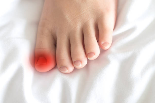 Ingrown nail or onychocryptosis concept. Foot of female Asia young adult with red spot on thumb Ingrown nail or onychocryptosis concept. Foot of female Asia young adult with red spot on thumb toenail stock pictures, royalty-free photos & images