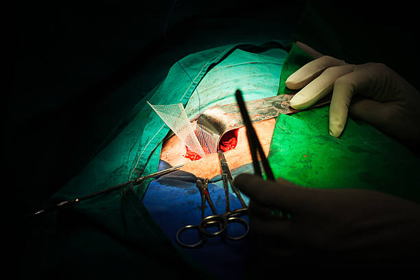 Inguinal Hernia Surgery inguinal hernia repair - mesh implantation hernia inguinal stock pictures, royalty-free photos & images