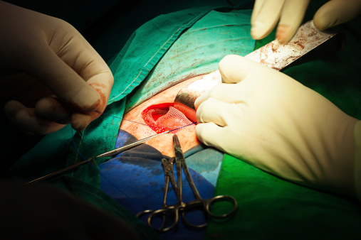 inguinal hernia surgeons