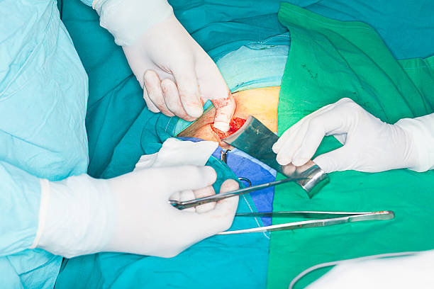 Inguinal Hernia Surgery inguinal hernia repair hernia inguinal stock pictures, royalty-free photos & images
