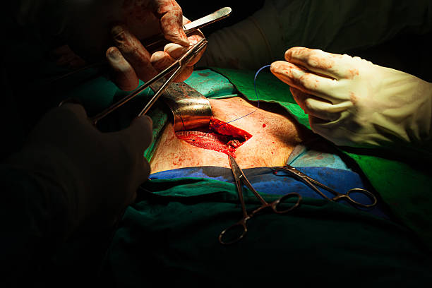 Inguinal Hernia Surgery inguinal hernia repair - mesh implantation hernia inguinal stock pictures, royalty-free photos & images