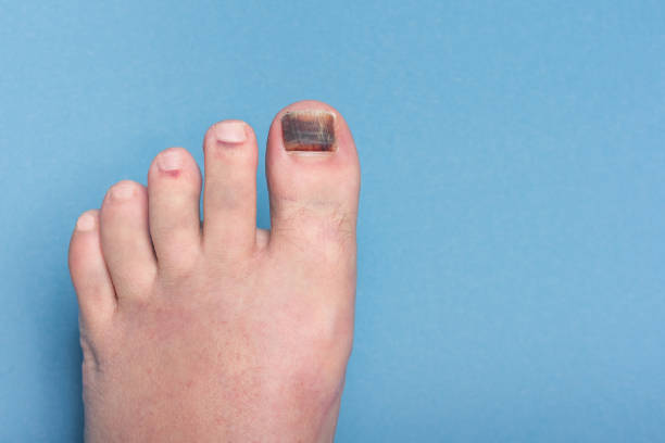 Injury to the nail of the big toe, hematoma and bruising under the nail. stock photo