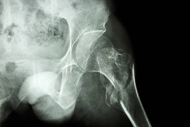 intertrochanteric fracture left femur film x-ray show intertrochanteric fracture left femur bone fracture stock pictures, royalty-free photos & images