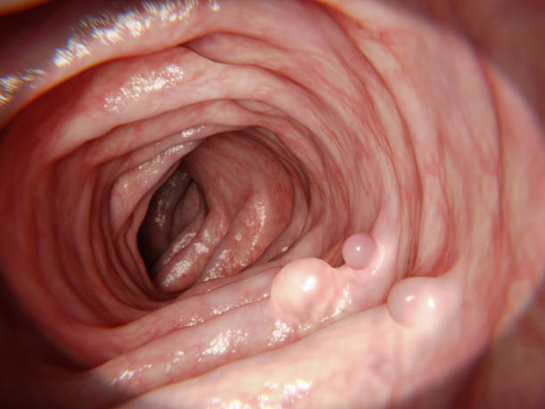 Intestinal polyps Polyps are a growth of tissue occurring on the lining of the colon or rectum.Untreated colorectal polyps can develop into colorectal cancer. colon stock pictures, royalty-free photos & images