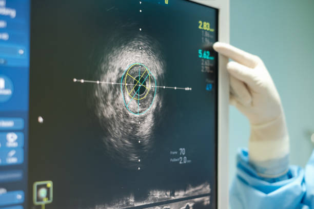 Intravascular ultrasound imaging (IVUS) stock photo