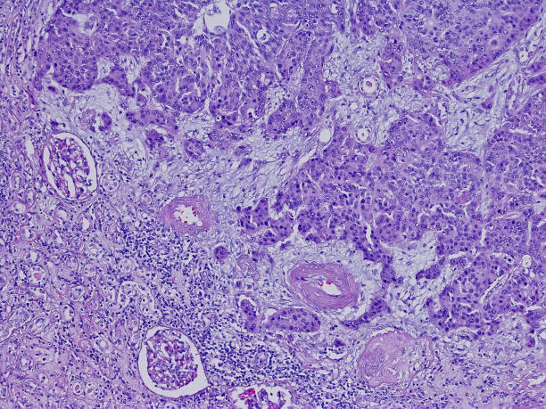 Invasive urothelial carcinoma nephroureterectomy in the kidney with vascular invasion stock photo
