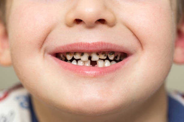 Kid patient open mouth showing cavities teeth decay. Close up of unhealthy baby teeth. Dental medicine and healthcare - human patient open mouth showing caries teeth decay  rotten teeth in children stock pictures, royalty-free photos & images