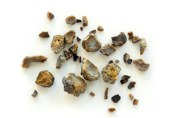 Kidney stones after ESWL intervention stock photo
