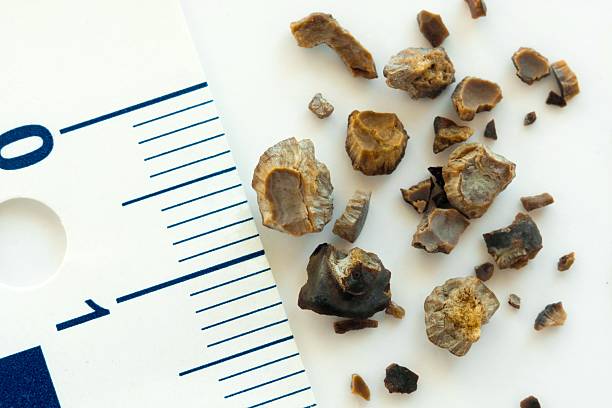 Kidney stones after ESWL intervention stock photo