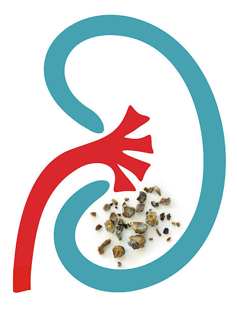 Kidney stones after treatment stock photo