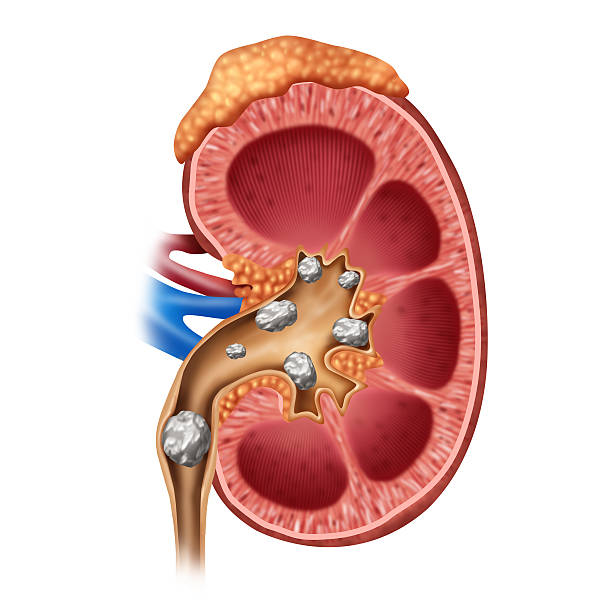 Kidney Stones Kidney stones medical concept as a human organ with painful crystaline mineral formations as a medical symbol with a cross section as a 3D illustration style. human internal organ photos stock pictures, royalty-free photos & images