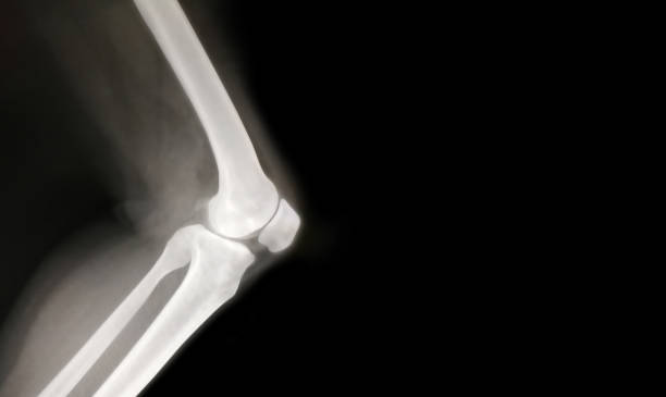 knee bone computer x-ray images stock photo