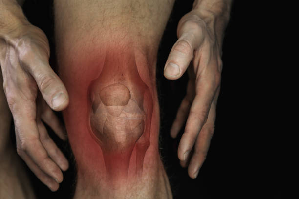 knieschmerzen. männliches bein mit knochengelenk-entzündung sendeform - gelenkrheumatismus stock-fotos und bilder