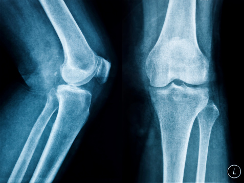 Кости колена фото Кости колена фото