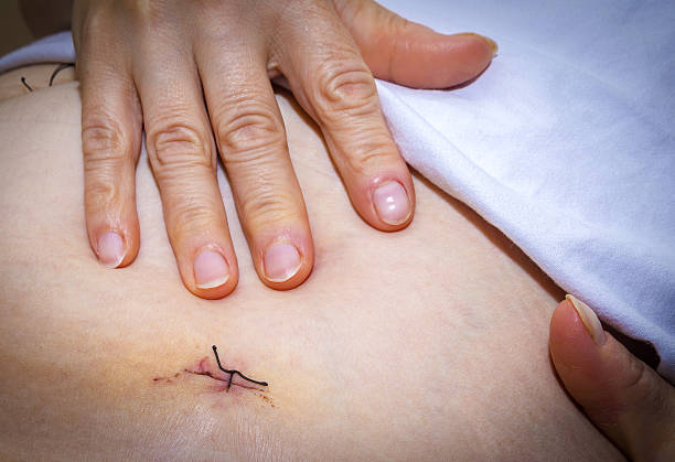 лапароскопические шрамы и синяки хирургии - appendix scar стоковые фото и и...