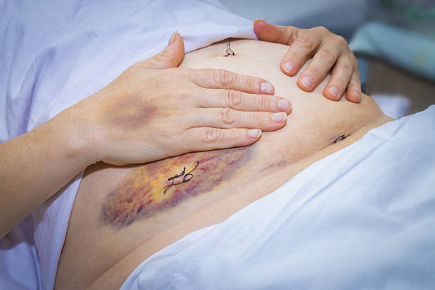 лапароскопические шрамы и синяки хирургии - appendix scars стоковые фото и ...