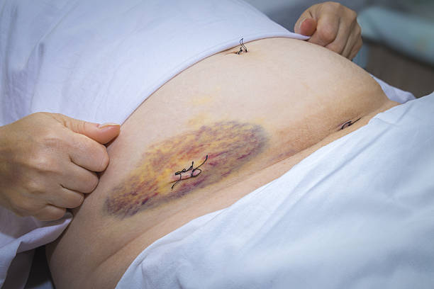 laparoscopic surgery scars and bruises - appendicitis scar stock photos and...