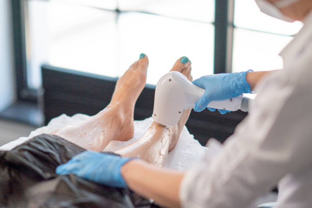 laser haar verwijderen epilation op benen - laser hair removal stockfoto's en -beelden