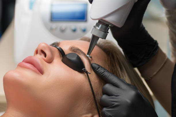 Laser removal of permanent makeup. The beautician removes the tattoo from the eyebrows. stock photo