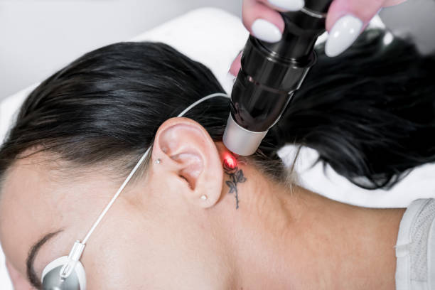 laser tattoo verwijdering behandelingssessie op patiënt, met behulp van pico technologie, af te breken tattoo inkt in kleinere deeltjes. bij een beauty-en huidverzorgings kliniek voor esthetische lasers. - tattoo stockfoto's en -beelden