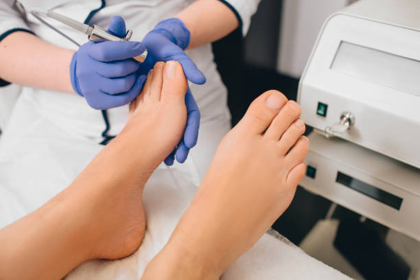 laser treatment on toenail, fungal infection on the toenails Patient receiving laser treatment on toenail, close-up. Fungal infection on the toenails. Onychomycosis treatment at clinic with medical laser toenail stock pictures, royalty-free photos & images