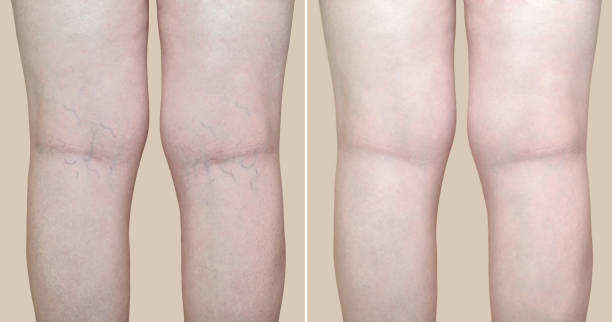 Legs of a woman with varicose veins and capillaries before and after medical treatment Legs of a middle aged woman with varicose veins and capillaries before and after medical treatment in front of stock pictures, royalty-free photos & images