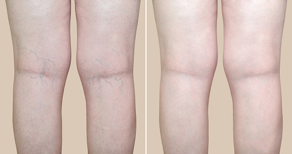 Biancat™ VitaVena Varicose Vein Cream